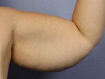 25-34 year old woman treated with Arm Lift before 1679043