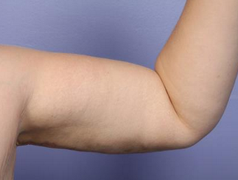 25-34 year old woman treated with Arm Lift after 1679043
