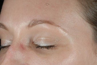 Botox after 989195