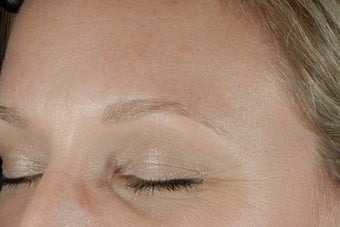 Botox before 989195
