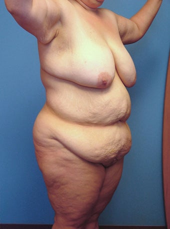 Body Lift 216790
