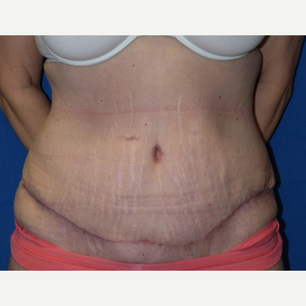 Tummy Tuck after 3743970