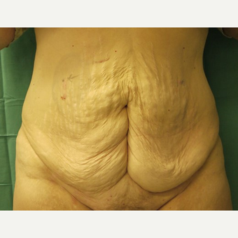 Tummy Tuck before 3743970