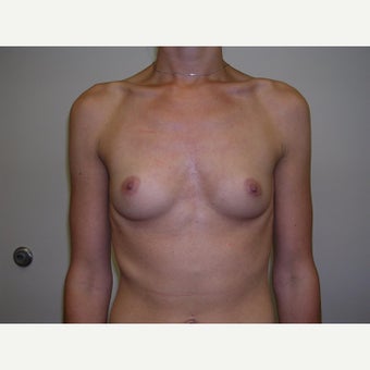 25-34 year old woman treated with Breast Augmentation before 2247921