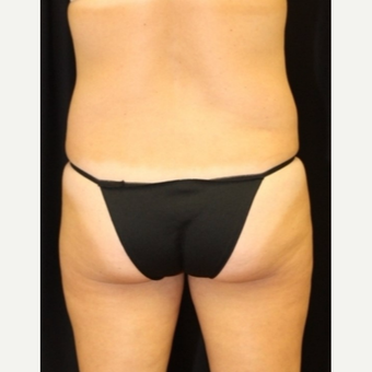 40 year old woman treated with CoolSculpting Non Surgical Fat Reduction after 3702308