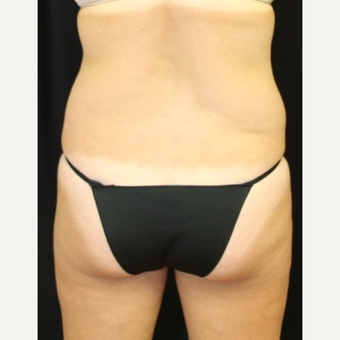 40 year old woman treated with CoolSculpting Non Surgical Fat Reduction before 3702308