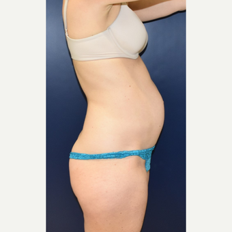 35-44 year old woman treated with Tummy Tuck before 3734123