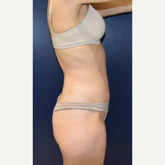 35-44 year old woman treated with Tummy Tuck after 3734123