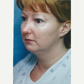 Patient treated with Laser Liposuction and Buccal fat extraction before 1618534