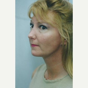 Patient treated with Laser Liposuction and Buccal fat extraction after 1618534