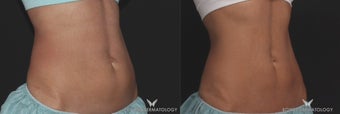 CoolSculpting reduces abdominal fat in 40-year-old fit woman before 1489685