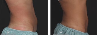 CoolSculpting reduces abdominal fat in 40-year-old fit woman 1489685