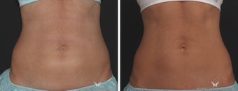 CoolSculpting reduces abdominal fat in 40-year-old fit woman after 1489685