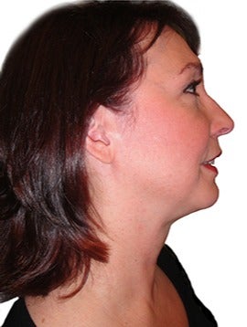 48 year old woman treated with closed neck lift after 2870077