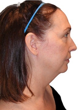 48 year old woman treated with closed neck lift before 2870077