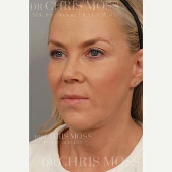 53 year old patient concerned with sagging of cheeks and jowls, and excess upper eyelid skin. after 3834697
