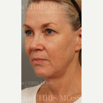 53 year old patient concerned with sagging of cheeks and jowls, and excess upper eyelid skin. before 3834697
