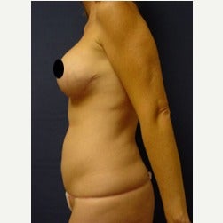 45-54 year old woman treated with Mini Tummy Tuck before 2074080