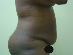 56 year old Tummy Tuck and liposuction before 1069965