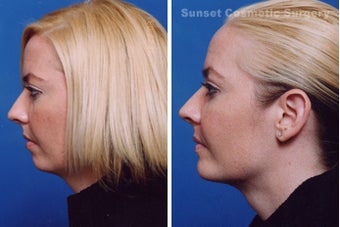 Submental Liposuction (chin/neck) with Chin Implant before 255547