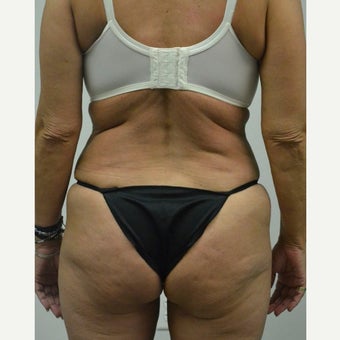 45-54 year old woman treated with Mini Tummy Tuck after 2211388