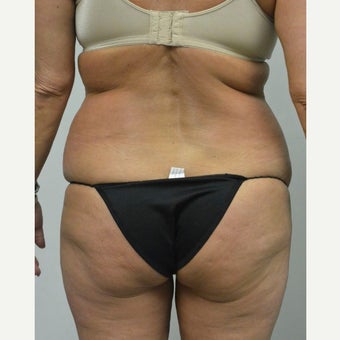 45-54 year old woman treated with Mini Tummy Tuck before 2211388