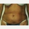 25-34 year old woman treated with Tummy Tuck before 1671160