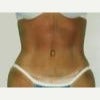 25-34 year old woman treated with Tummy Tuck after 1671160