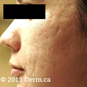 Acne Scars Treatment - 28 year old woman treated with fractional laser twice before 1718713