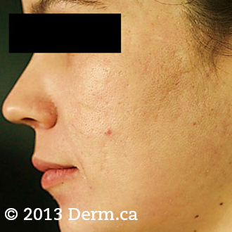 Acne Scars Treatment - 28 year old woman treated with fractional laser twice after 1718713