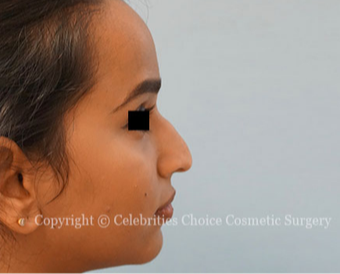 18-24 year old woman treated with Rhinoplasty before 3768589