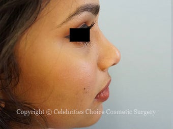 18-24 year old woman treated with Rhinoplasty after 3768589