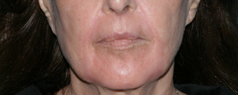 Before and After Fraxel Laser after 1064711