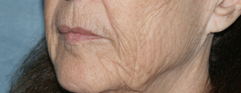 Before and After Fraxel Laser 1064711