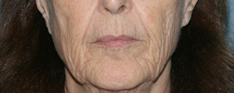 Before and After Fraxel Laser before 1064711