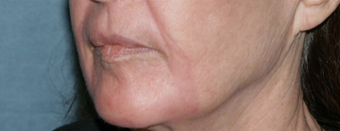Before and After Fraxel Laser 1064711