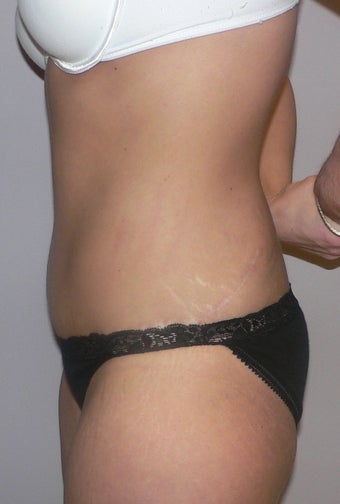 41 year old woman has Tummy Tuck 990575