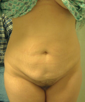 41 year old woman has Tummy Tuck before 990575