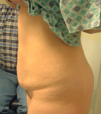 41 year old woman has Tummy Tuck 990575