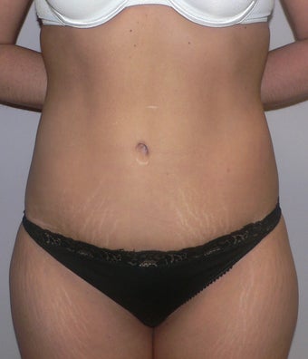 41 year old woman has Tummy Tuck after 990575