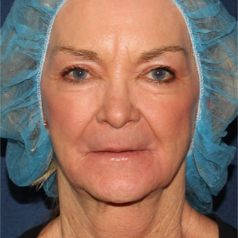 67 year old woman treated one time with Laser Resurfacing after 3630310