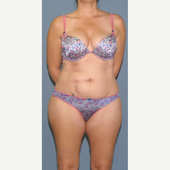 45-54 year old woman treated with Tummy Tuck before 3563650