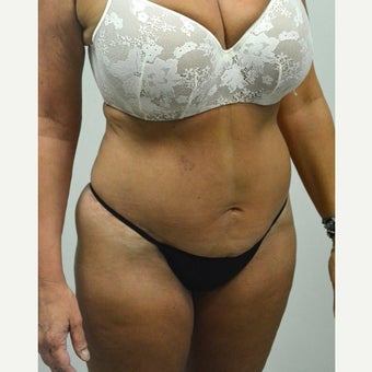 45-54 year old woman treated with Mini Tummy Tuck after 2211383