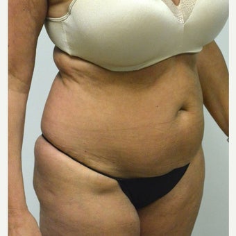 45-54 year old woman treated with Mini Tummy Tuck before 2211383