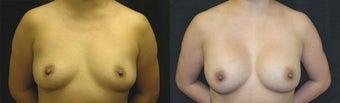 32 year old woman treated with Breast Augmentation before 2990414