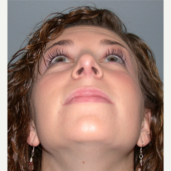 18-24 year old woman treated with Rhinoplasty after 3692299