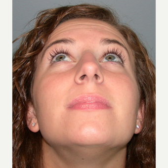 18-24 year old woman treated with Rhinoplasty before 3692299