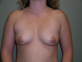 26 Year Old Female - Breast Augmentation before 1446768