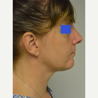 45-54 year old woman treated with Chin Implant after 3224986