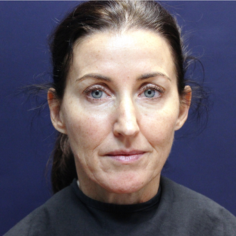 45-54 year old woman treated with Injectable Fillers before 3202219